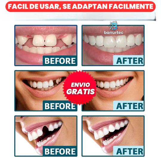 Carillas Dentales Snap On Smile🦷 | Luce una Sonrisa Soñada